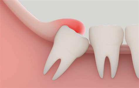 The Curse of the Flap: What to Do About that Pesky Skin Over Your Wisdom Tooth