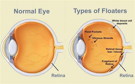 What Causes Eye Floaters?