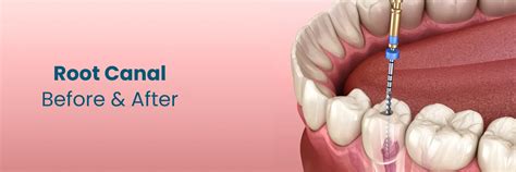 Flying After Root Canal