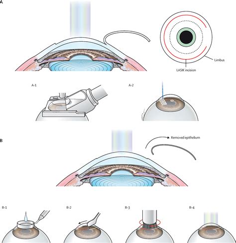 Focus on Cataract and Refractive Surgery