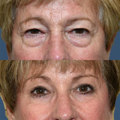 Focus on Upper Blepharoplasty