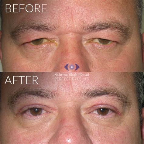 Follow-up Appointments for Eyelid Surgery