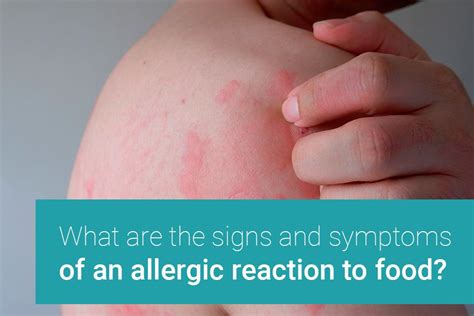 The Hidden Dangers of Food Allergies: Don't Let an Innocent Bite Turn into a Catastrophic Rash