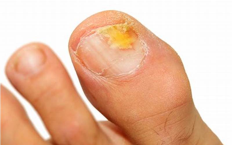 Embarrassed to Get a Pedicure? Tips for Dealing with Fungal Infections