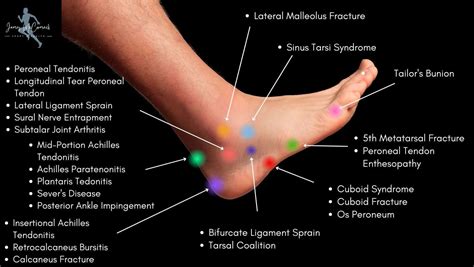 Foot Pain Chart: Understanding The Causes And Solutions