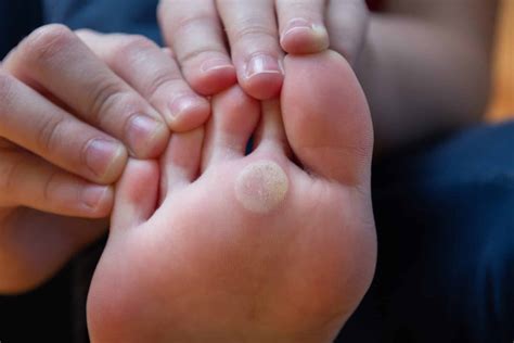 Foot Calluses: Prevention & Effective Treatment