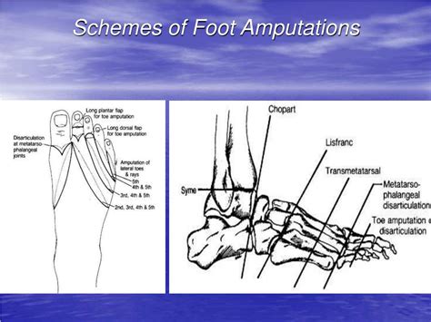 Foot Problems and Amputations