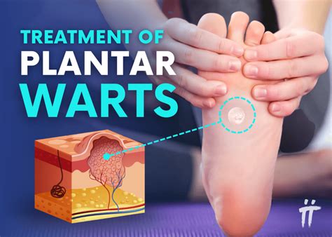 Foot Warts: 8 Proven Removal Methods