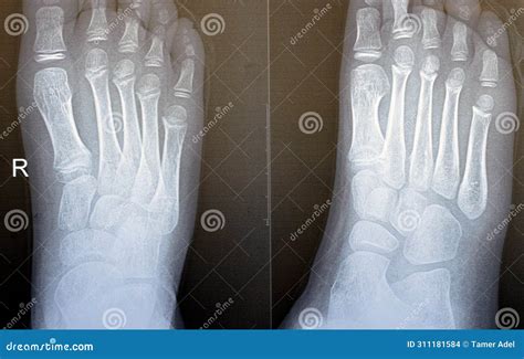 Foot X Ray Image
