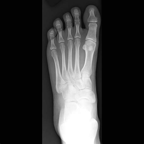 Foot Xray Image