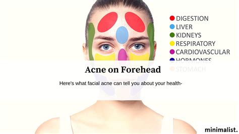 Forehead Acne: Causes & Clear Skin Solutions