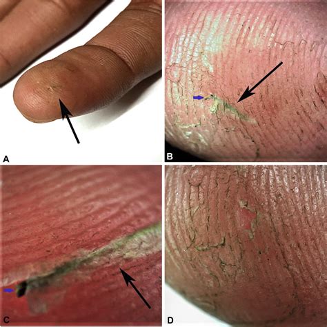 Effective and Safe Foreign Object Under Skin Removal Services.