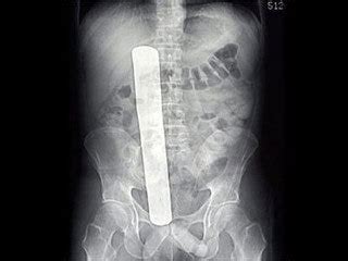 Foreign Objects and Trauma