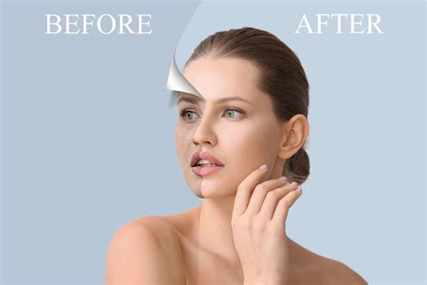 Observe the Marvelous Results of Forma Skin Tightening Before and After: Witness The Amazing Transformation Yourself!