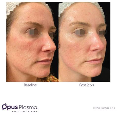 Revitalize Your Skin with the Revolutionary Fractional Plasma Skin Resurfacing Technology