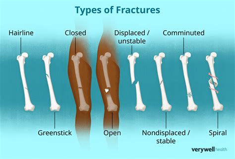 Fractures