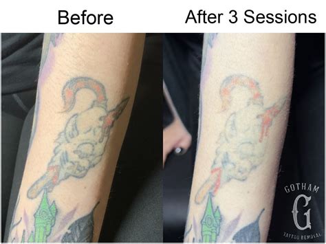 Free tattoo removal for sextrafficking survivors in NYC