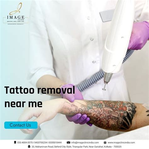 Free Tattoo Removal Near Me