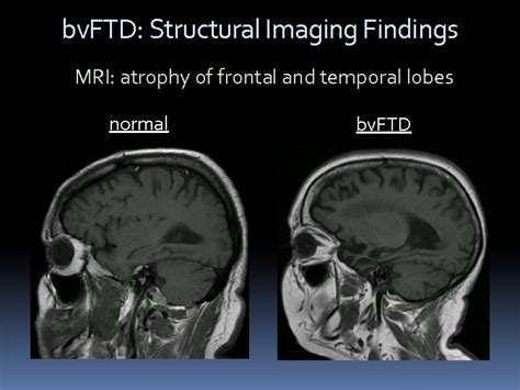 Frontotemporal Dementia MRI vs Normal
