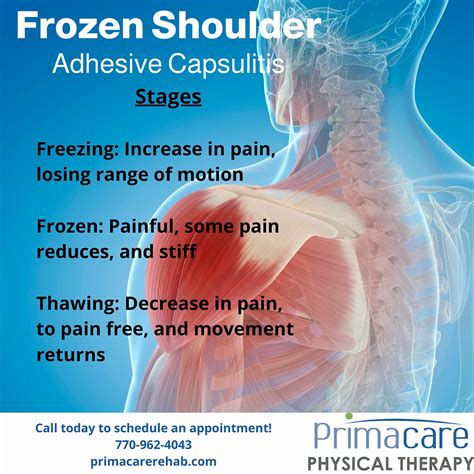 Frozen Shoulder Adhesive Capsulitis The Prime Culprit