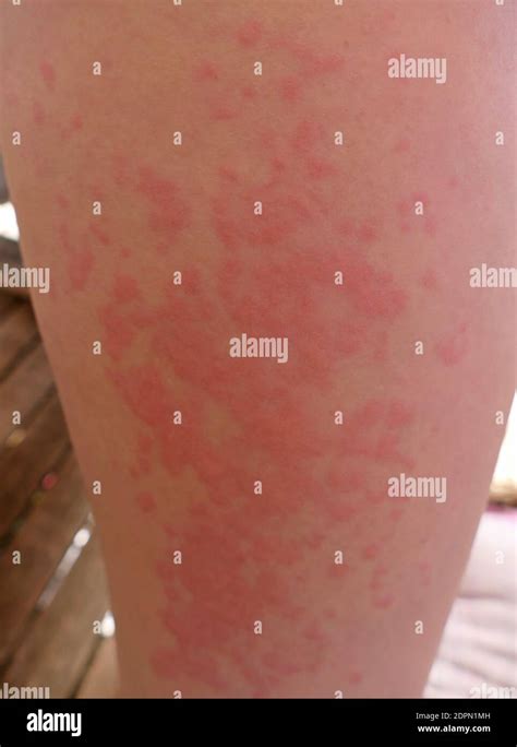 Fruit Rash Pictures
