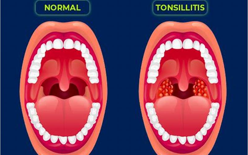 Gambar Tonsilitis