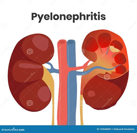 Pyelonefritis Obstruktif