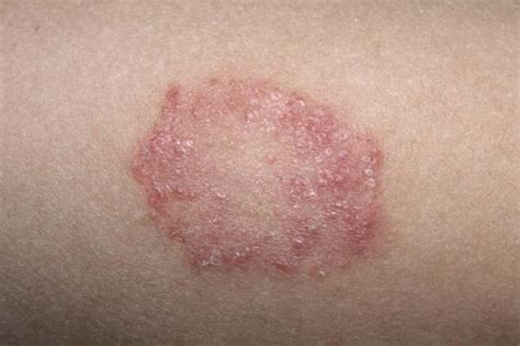 Gatal Akibat Infeksi Jamur