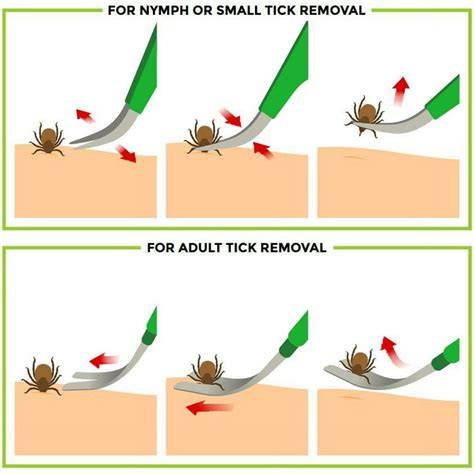 Gathering Your Tick Removal Toolkit