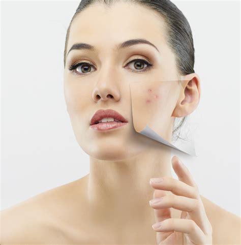 Female Adult Acne Treatment