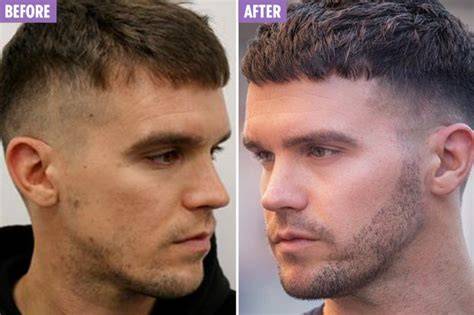 Gaz Beard Transplant