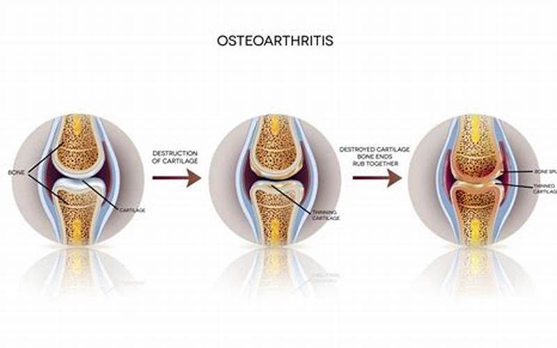 Gejala Osteoartritis