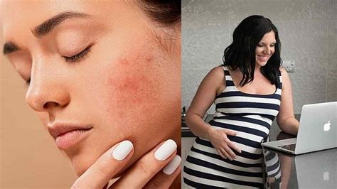 Gejala Jerawat Hamil