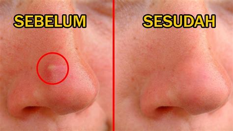 Gejala jerawat di hidung