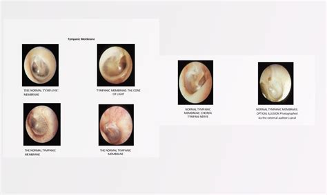 Apa yang Perlu Diketahui tentang Gendang Telinga yang Pecah? KAFE KEPO