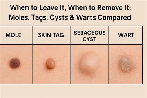 Understanding the Difference: Genital Wart vs Skin Tag