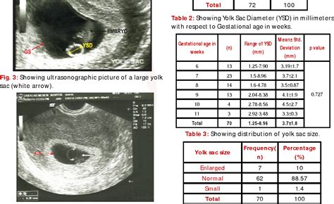 Gestational Sac Size Chart