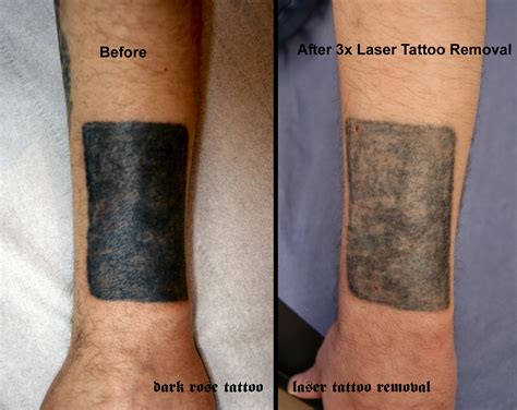 Tattoo Removal Procedure How To Remove Tattoos From