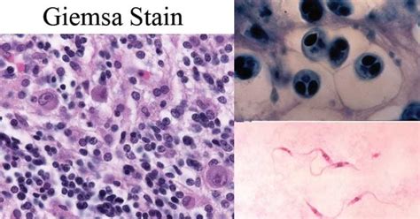 Giemsa Stain Test and interpretation