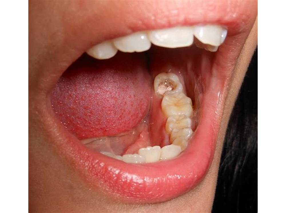 Tingkat Keparahan Lubang Gigi