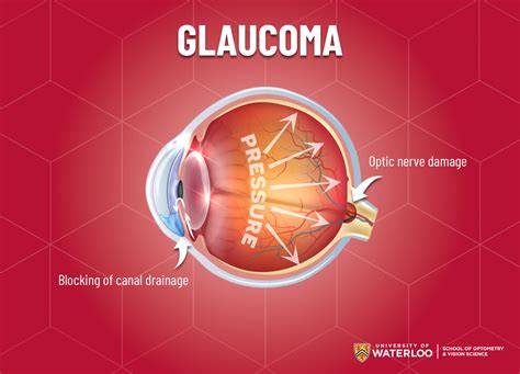 Glaucoma: A Serious Pressure Issue