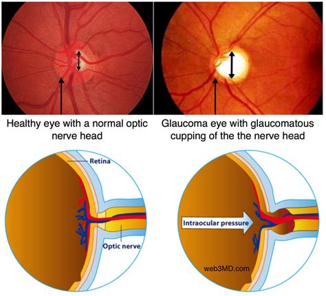 Glaucoma: The Pressure Problem