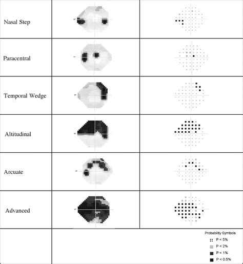 Glaucoma Visual Field Loss Pattern
