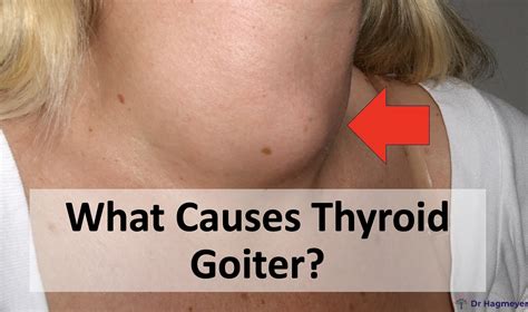 Goiter & Basedow’s: Causes, Symptoms, & Treatment