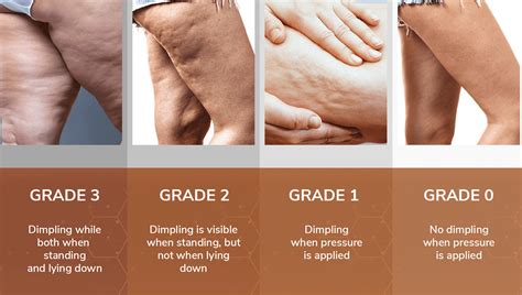 Goodbye Cellulite: Causes & Effective Treatments