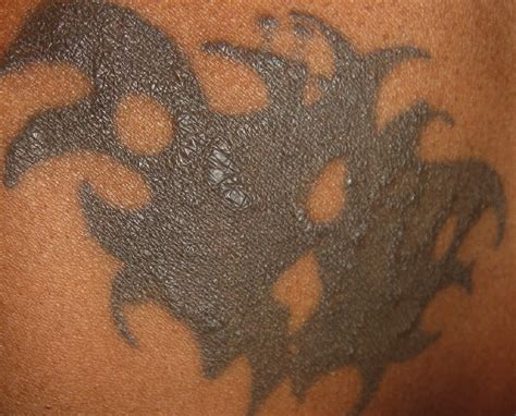 Granulomas On Tattoo