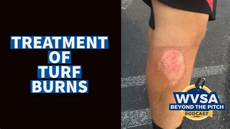 The Scorching Truth: How Grass Burn on Skin Can Leave You Office-Bound!