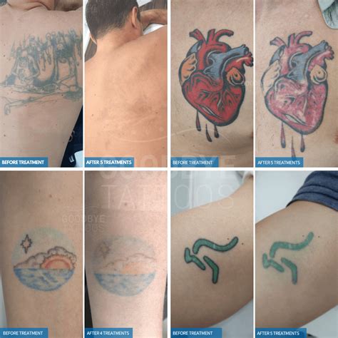 Best Tattoo Removal for Green Ink Laser Skin Care Clinic