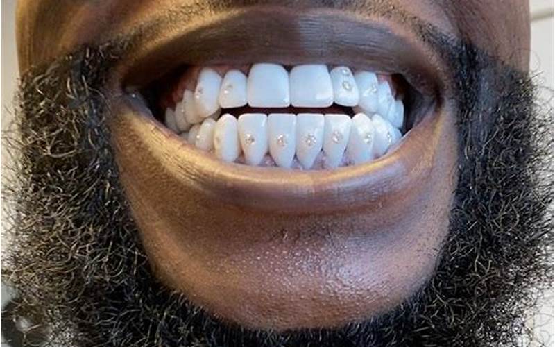 Gucci Mane Before and After Teeth: How His Smile Changed Over Time