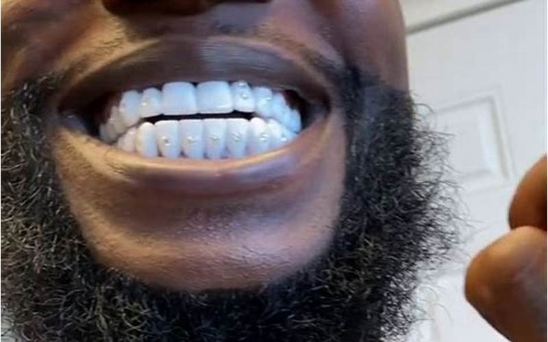 Gucci Mane'S New Teeth